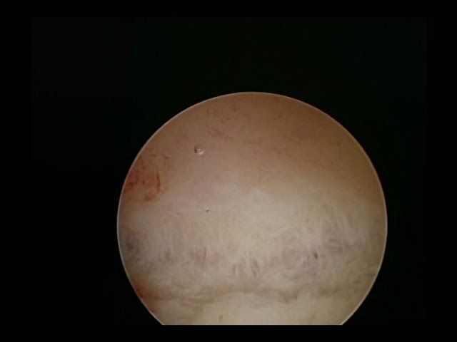 arcuate fundus