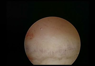 Arcuate Fundus
