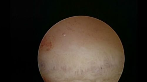 arcuate fundus