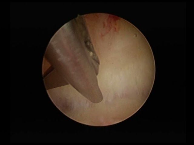 arcuate with sever endometritis