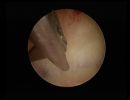 arcuate with sever endometritis