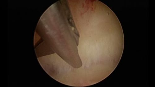 arcuate with sever endometritis