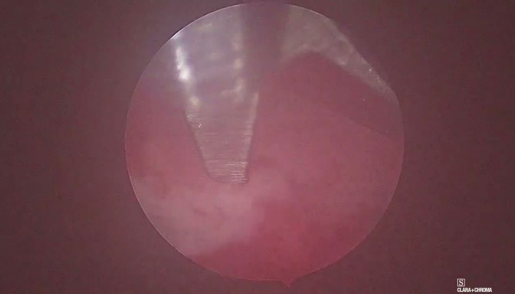 big septum giotaki