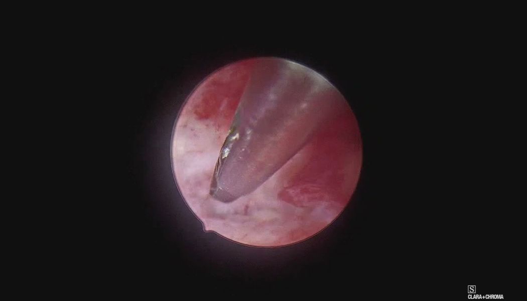 endometritis 349