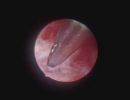 endometritis 349