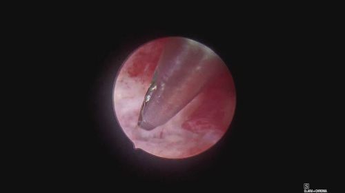 endometritis 349