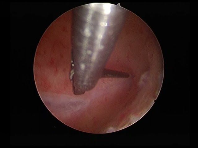endometritis 350
