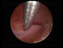 endometritis 350