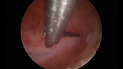 endometritis 350