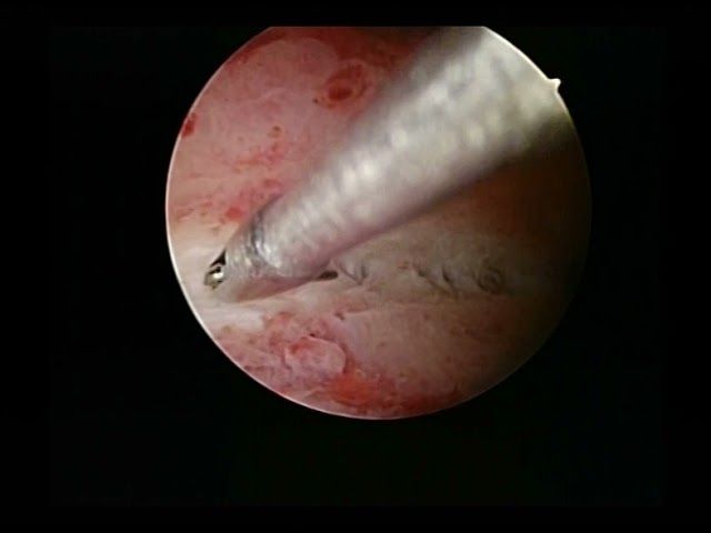 endometritis 351