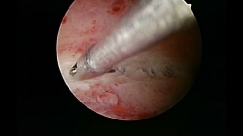endometritis 351