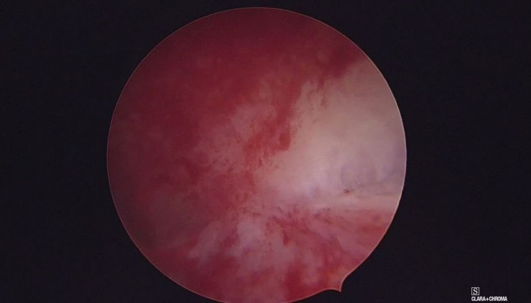 endometritis 352
