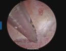 endometritis