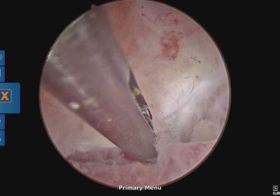 Endometritis Videos