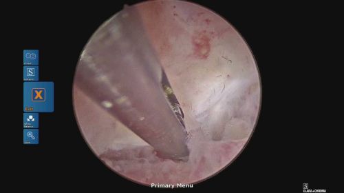 endometritis