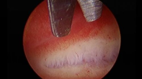 endometritis