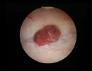 endometritis
