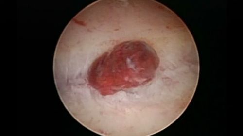 endometritis