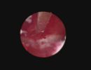 endometritis