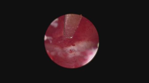 endometritis