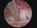 endometritis