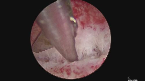 endometritis
