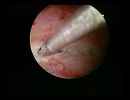 endometritis lateral adhesions