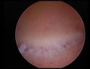 flat polyps