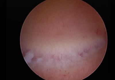 Polyps Videos