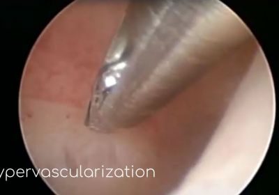 hypervascularization