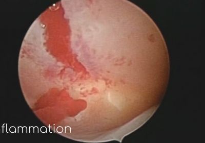 Inflammation videos
