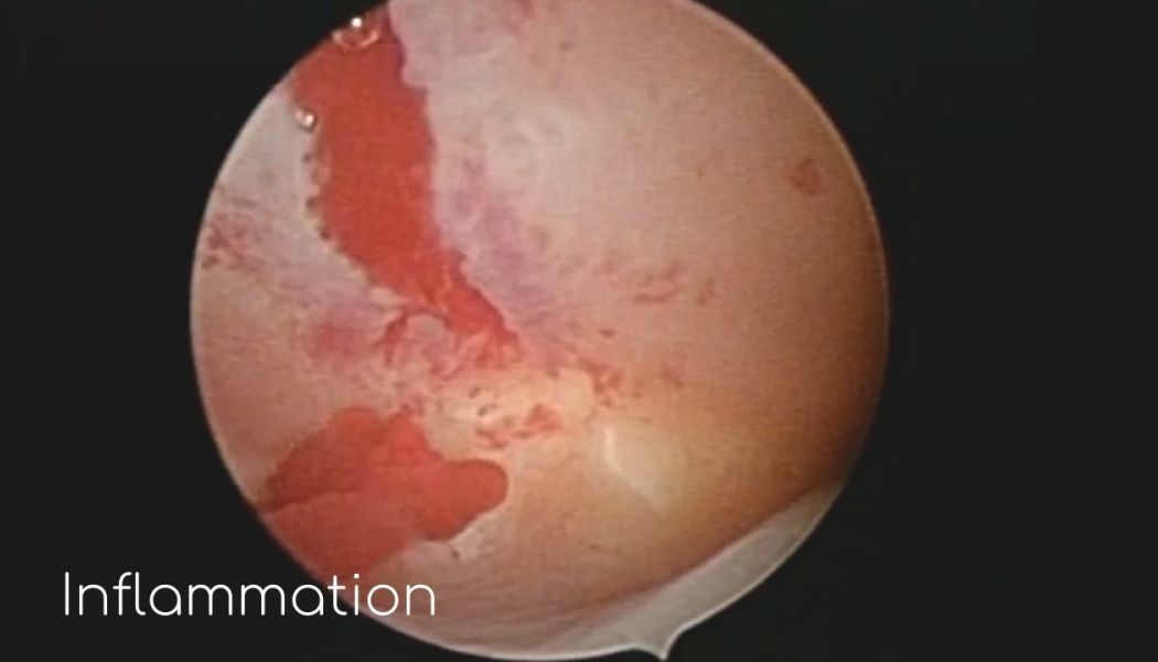 multiple inflammation