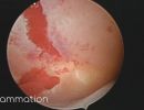multiple inflammation