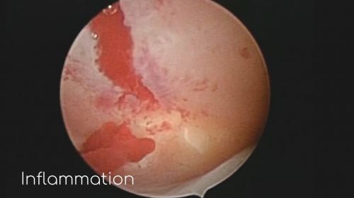 multiple inflammation