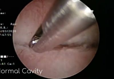 Normal Cavity