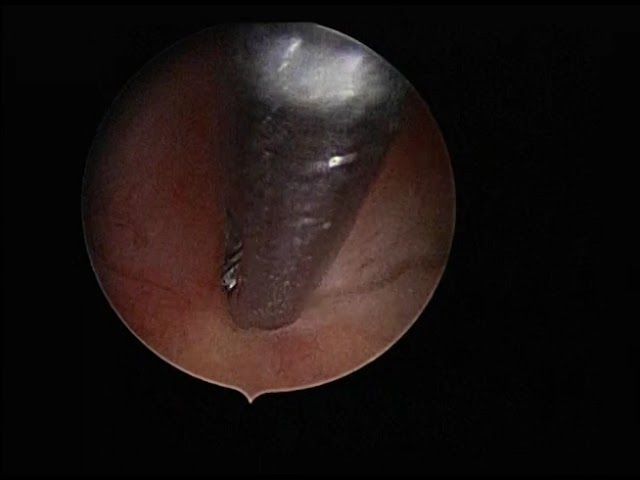 septum hypervascularization