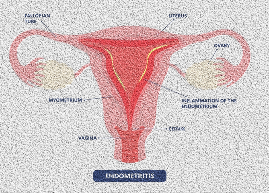 Infection of the Endometrium-Endometritis