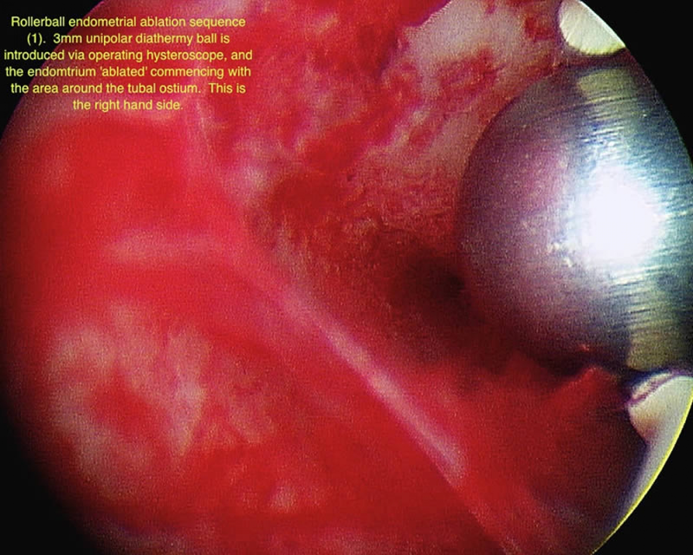Endometrial ablation for Abnormal Uterine Bleeding