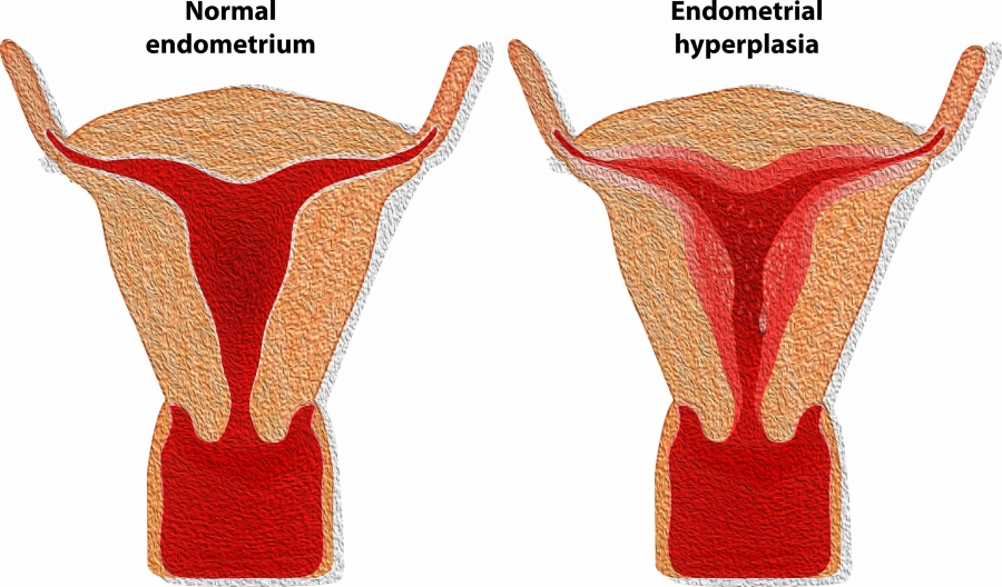 Endometrial Hypertrophy/Hyperplasia