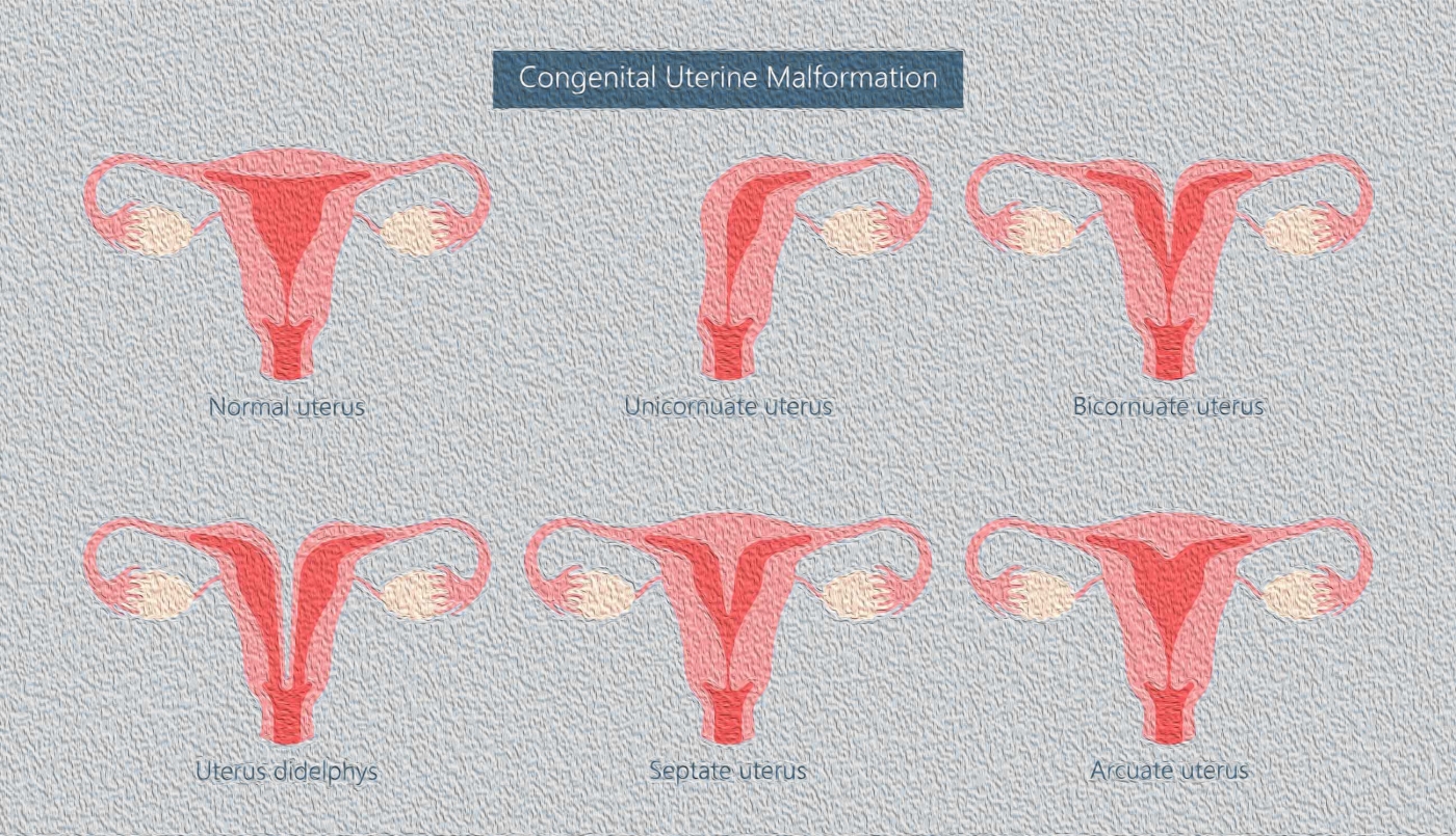 Uterine Septum