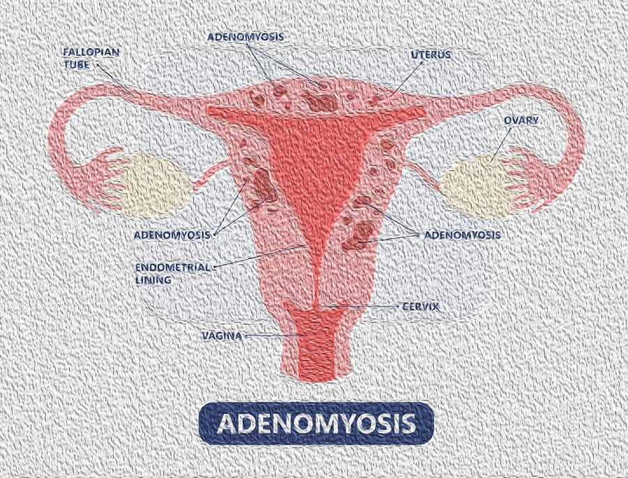 Adenomyosis